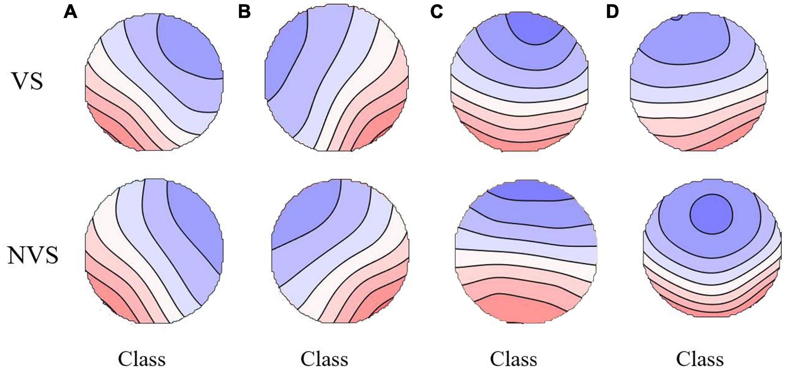 Abnormalities in electroencephalographic microstates among violent patients with schizophrenia